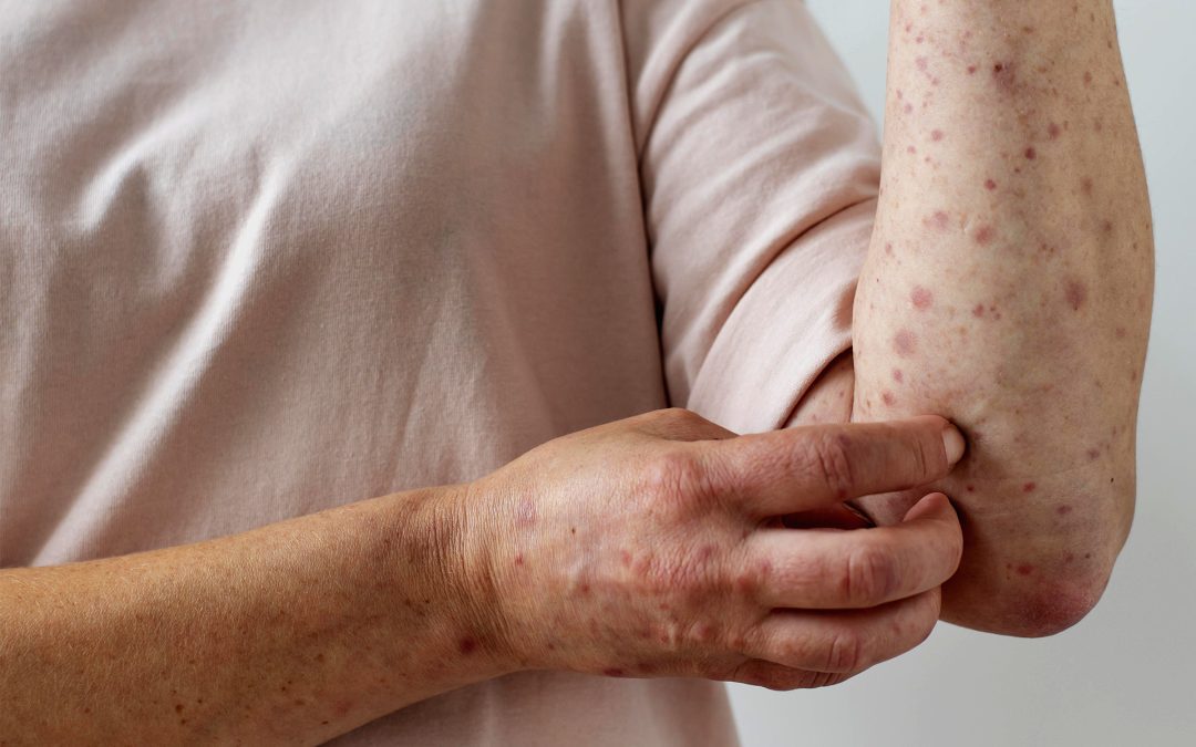 El Ministerio de Salud realiza tareas de vigilancia ante probable caso de sarampión en Villa del Rosario