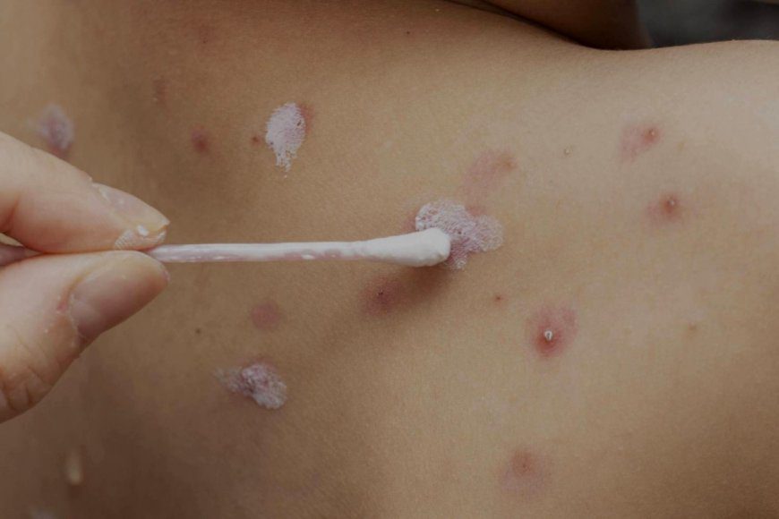 Brote de varicela en Entre Ríos: Salud confirmó que hay 700 casos y la mayoría son adolescentes