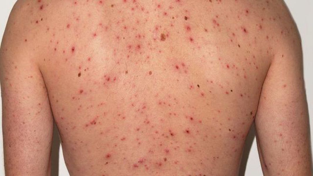 Reportaron un caso sospechoso de sarampión en Federación