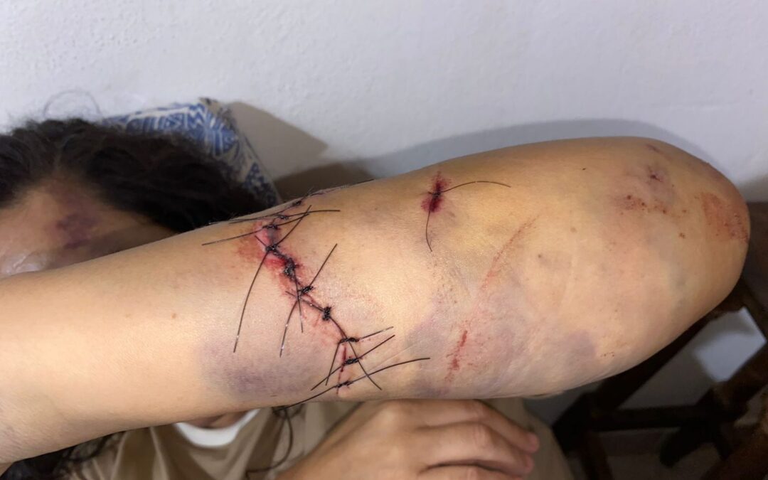 De «gresca familiar» a intento de homicidio: El tremendo caso de la enfermera de Santa Ana atacada con un hacha